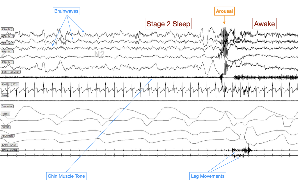 EEG Arousal