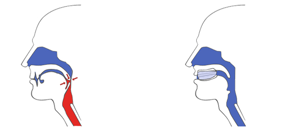 Diagram restricted airway  and an open airway due to SnorBan